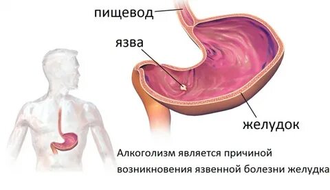 Избыточное употребление алкоголя